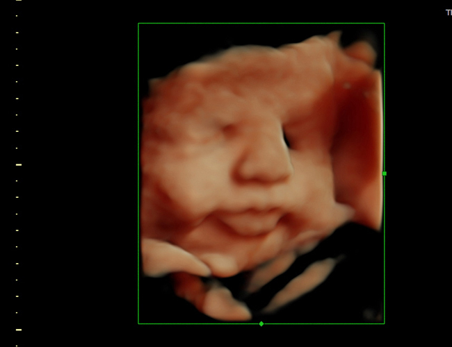 3D ultrasound image at 33 weeks